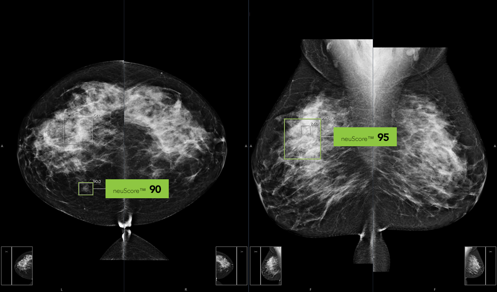 Evaluation Of Dense Breasts Curemetrix Dense Breast Mammogram